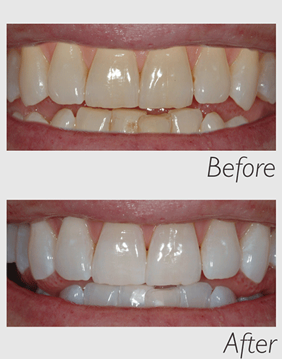 Before and After tooth whitening Ballina